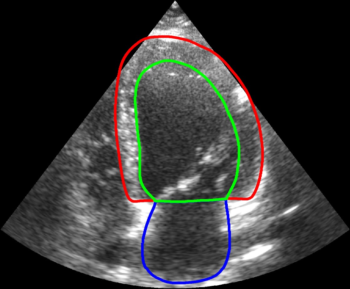 patient0001_4CH_ED_1.jpg